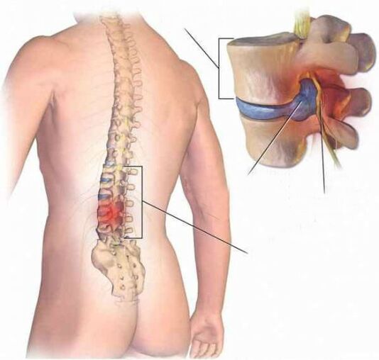 Hernia intermedia